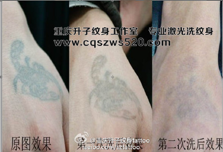 重庆专业激光洗纹身