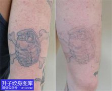 <b>重庆洗纹身大臂外侧激光清洗纹身过程</b>