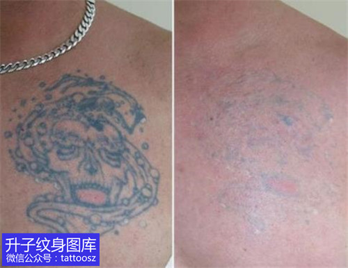 重庆洗纹身 一个帅哥胸部的骷髅纹身清洗后效果