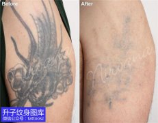 <b>重庆激光洗纹身 手臂清洗纹身效果图片</b>