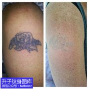 <b>重庆洗纹身 大臂外侧玫瑰花洗纹身效果图</b>