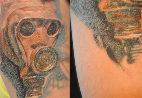 以下为纹身皮损正常现象案例图片