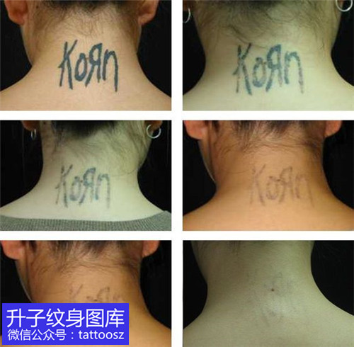 重庆小姐姐后脖子英文字母洗纹身后对比效果